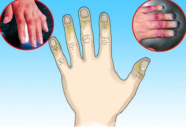 Bỏng lạnh - Hình ảnh minh họa